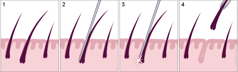Wirkungsweise der Elektroepilation